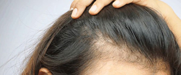 Alopecie ou chute des cheveux à la Baule - dr Potet